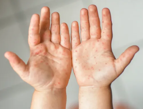 Measles outbreak in Mallorca: six confirmed cases and Public Health activates control measures